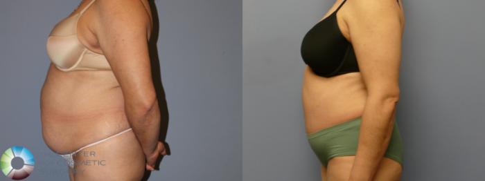 Before & After Tummy Tuck Case 11992 Left Side in Denver and Colorado Springs, CO