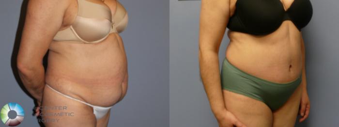 Before & After Tummy Tuck Case 11992 Right Oblique in Denver and Colorado Springs, CO