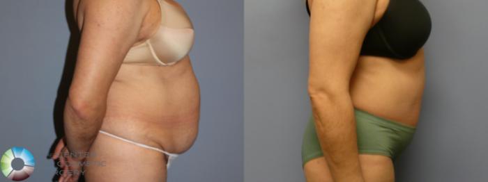 Before & After Tummy Tuck Case 11992 Right Side in Denver and Colorado Springs, CO