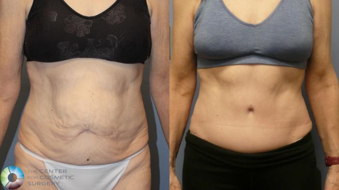 Before & After Tummy Tuck Case 11993 Front in Denver and Colorado Springs, CO