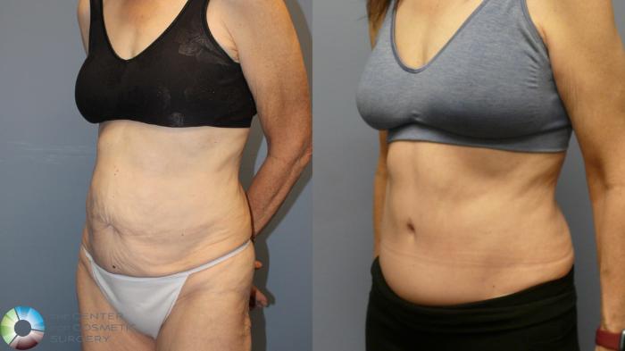 Before & After Tummy Tuck Case 11993 Left Oblique in Denver and Colorado Springs, CO