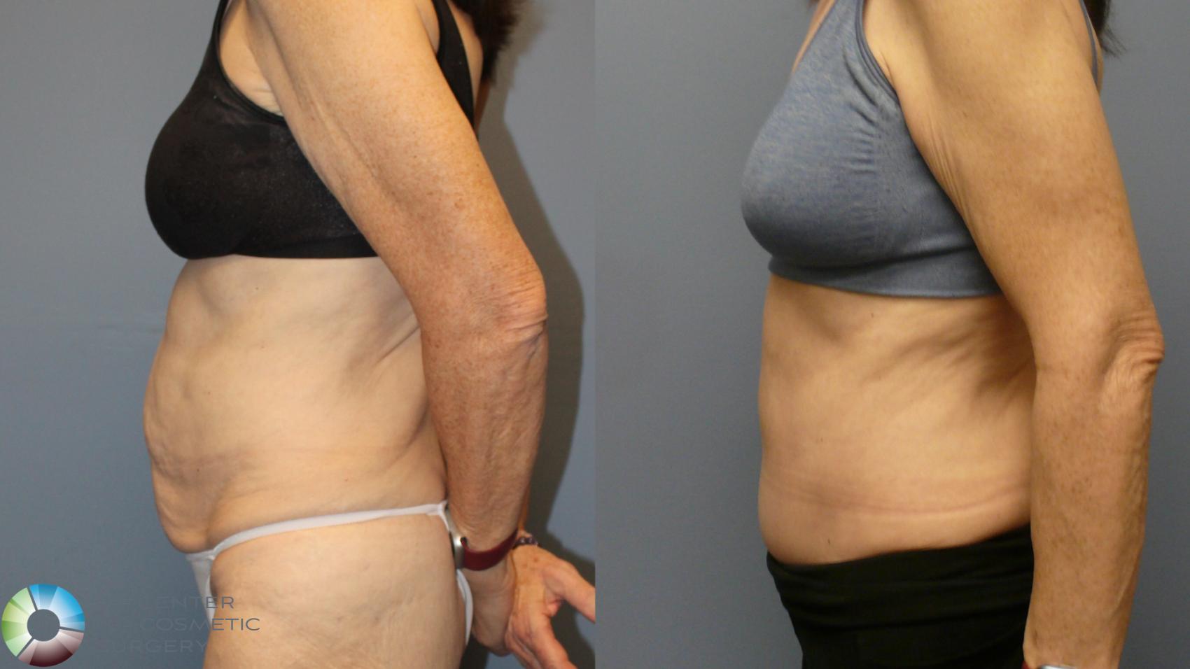 Before & After Tummy Tuck Case 11993 Left Side in Denver and Colorado Springs, CO
