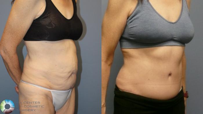Before & After Tummy Tuck Case 11993 Right Oblique in Denver and Colorado Springs, CO