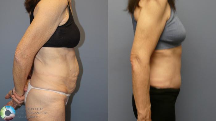 Before & After Tummy Tuck Case 11993 Right Side in Denver and Colorado Springs, CO