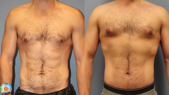 Before & After Tummy Tuck Case 11998 Front in Denver and Colorado Springs, CO