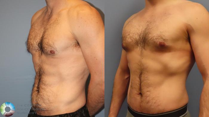 Before & After Tummy Tuck Case 11998 Left Oblique in Denver and Colorado Springs, CO