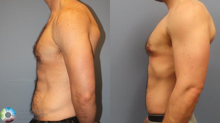 Before & After Tummy Tuck Case 11998 Left Side in Denver and Colorado Springs, CO