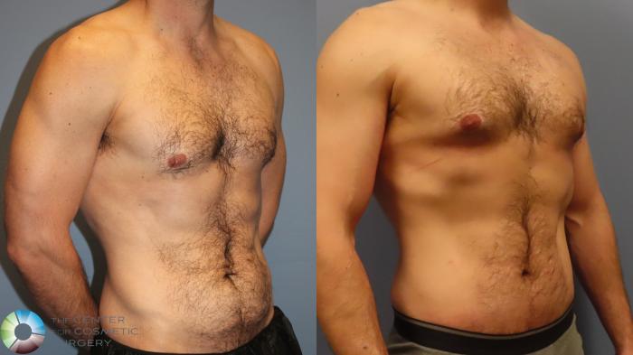 Before & After Tummy Tuck Case 11998 Right Oblique in Denver and Colorado Springs, CO