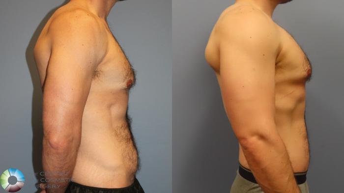 Before & After Tummy Tuck Case 11998 Right Side in Denver and Colorado Springs, CO