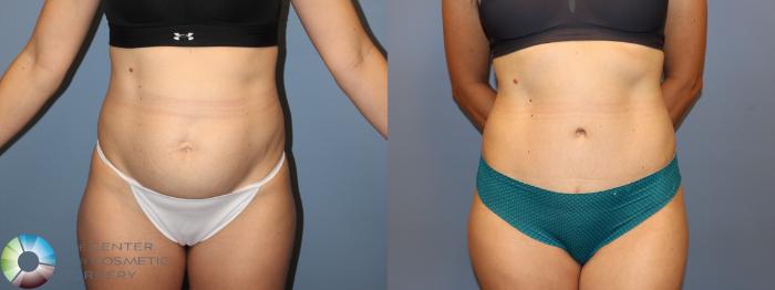 Before & After Tummy Tuck Case 12003 Front in Denver and Colorado Springs, CO