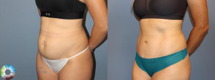 Before & After Tummy Tuck Case 12003 Left Oblique in Denver and Colorado Springs, CO