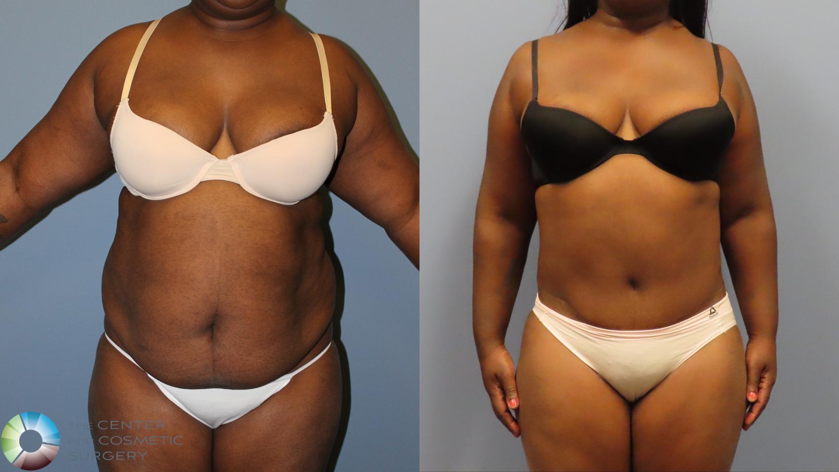 Before & After Tummy Tuck Case 12009 Front in Denver and Colorado Springs, CO