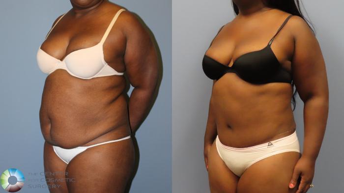 Before & After Tummy Tuck Case 12009 Left Oblique in Denver and Colorado Springs, CO