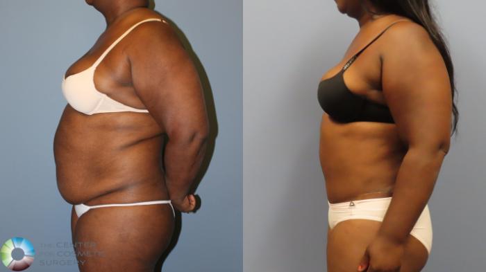 Before & After Liposuction Case 12009 Left Side in Denver and Colorado Springs, CO