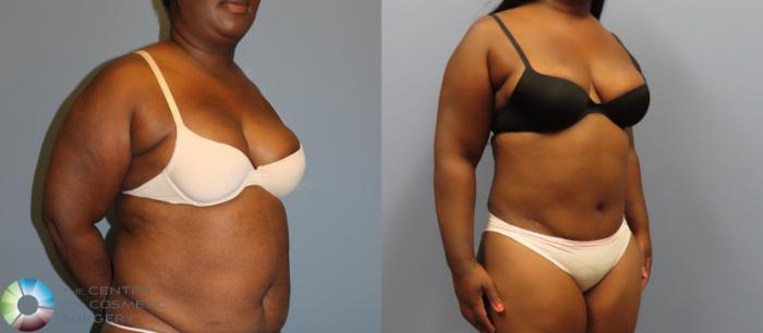 Before & After Tummy Tuck Case 12009 Right Oblique in Denver and Colorado Springs, CO