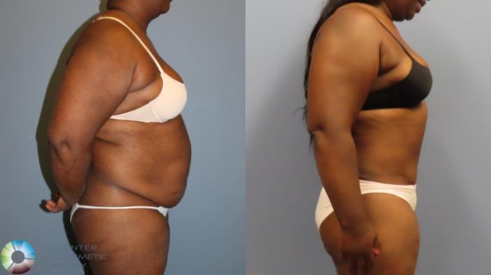 Before & After Tummy Tuck Case 12009 Right Side in Denver and Colorado Springs, CO