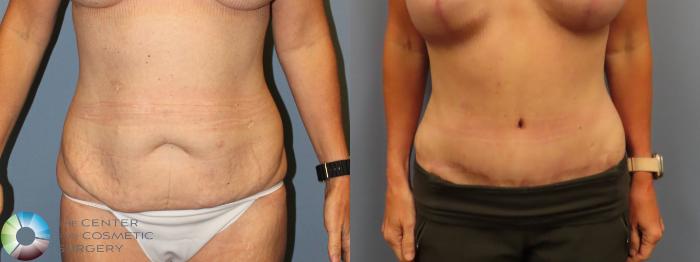 Before & After Tummy Tuck Case 12020 Front in Denver and Colorado Springs, CO