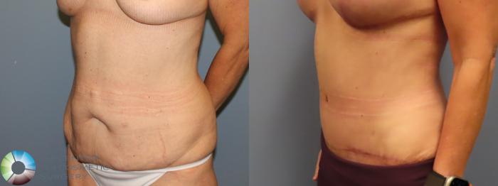 Before & After Tummy Tuck Case 12020 Left Oblique in Denver and Colorado Springs, CO