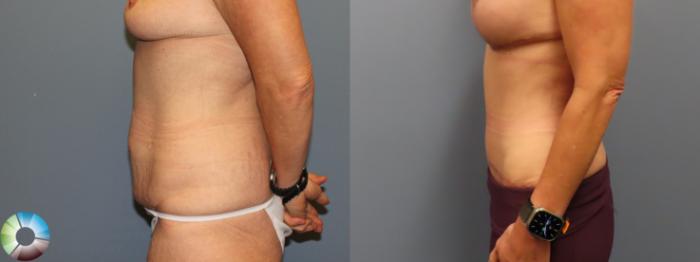 Before & After Tummy Tuck Case 12020 Left Side in Denver and Colorado Springs, CO