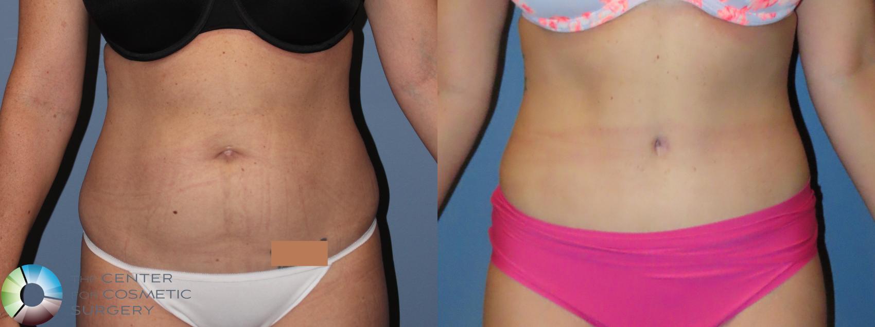 Before & After Tummy Tuck Case 12043 Front in Denver and Colorado Springs, CO