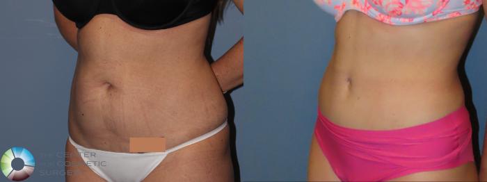 Best Denver Abdominoplasty/Tummy Tuck