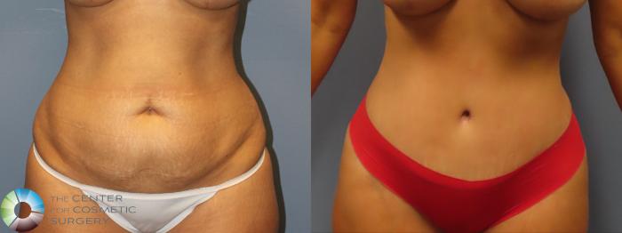 Best Denver Abdominoplasty/Tummy Tuck