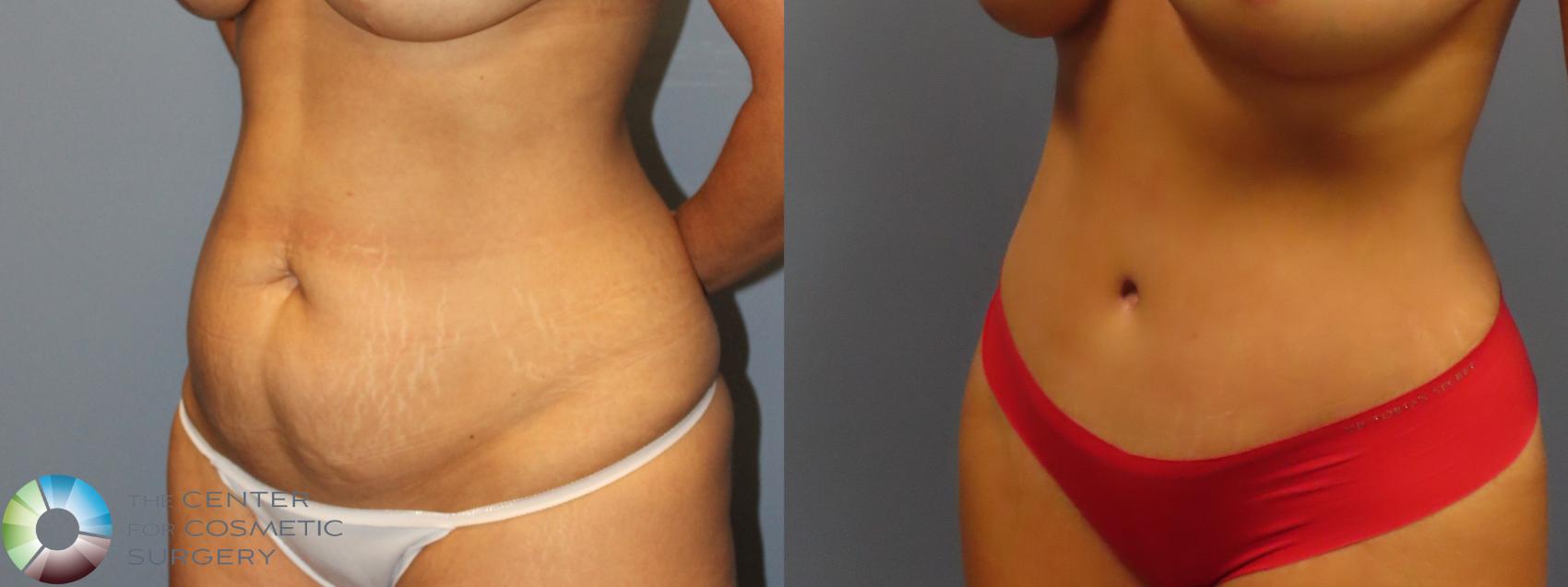 Before & After Tummy Tuck Case 12049 Left Oblique in Denver and Colorado Springs, CO