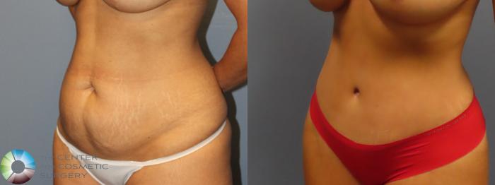 Best Denver Abdominoplasty/Tummy Tuck