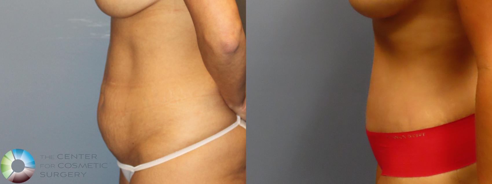Before & After Tummy Tuck Case 12049 Left Side in Denver and Colorado Springs, CO