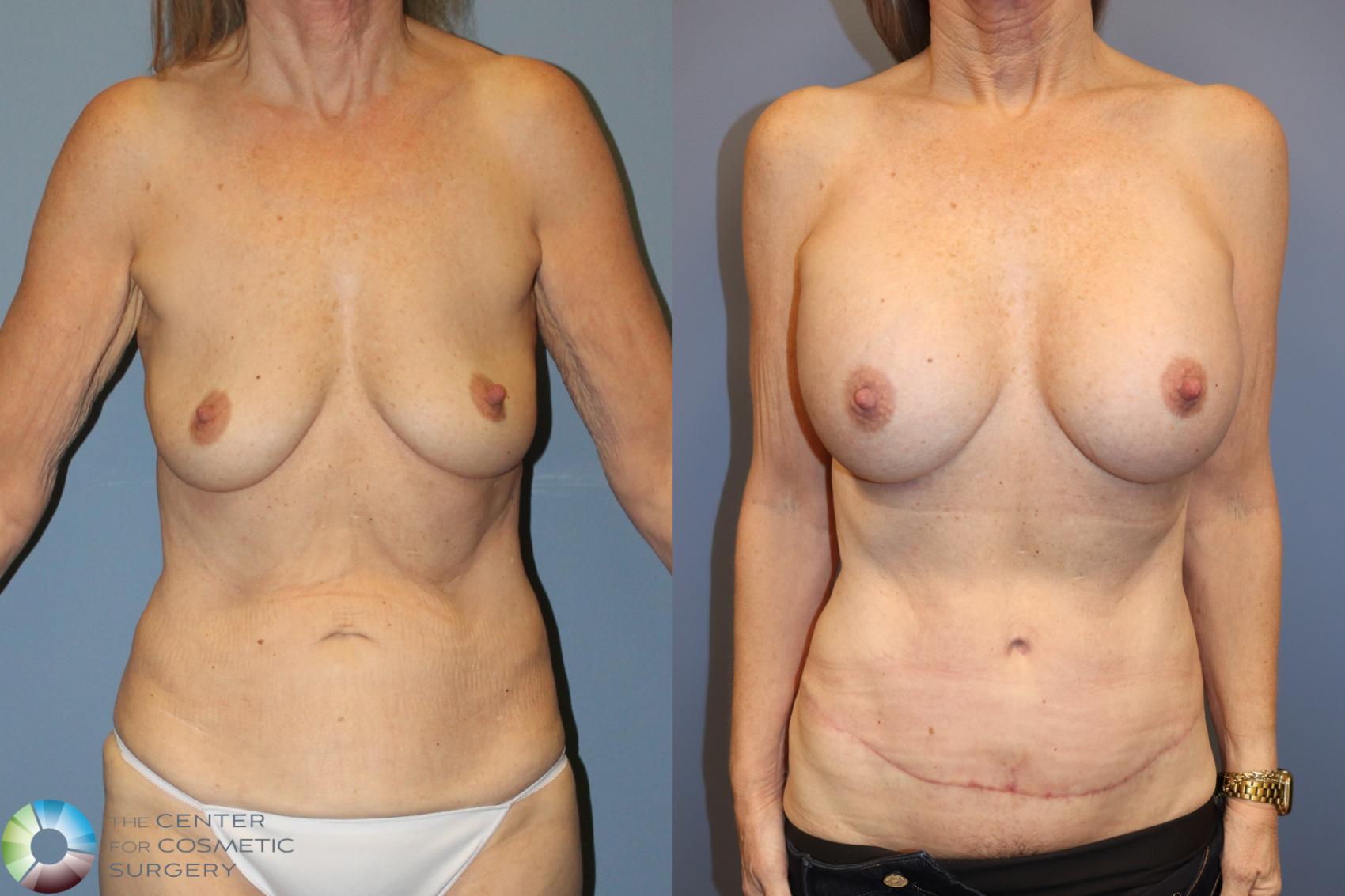 Before & After Breast Augmentation Case 12059 Front in Denver and Colorado Springs, CO