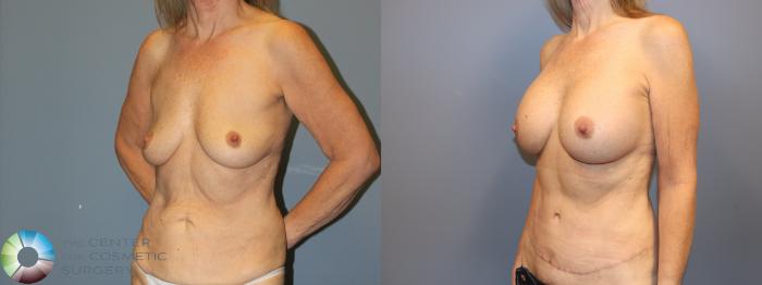 Before & After Breast Augmentation Case 12059 Left Oblique in Denver and Colorado Springs, CO