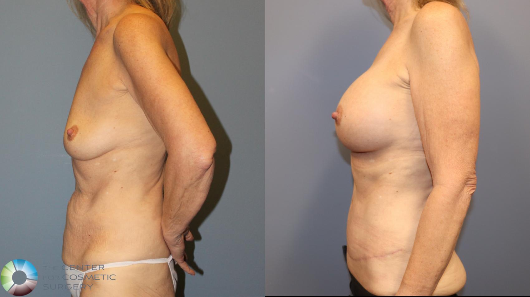 Before & After Tummy Tuck Case 12059 Left Side in Denver and Colorado Springs, CO