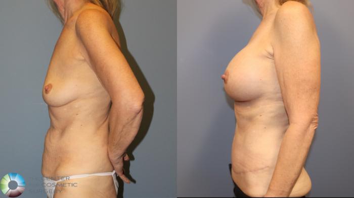 Before & After Breast Augmentation Case 12059 Left Side in Denver and Colorado Springs, CO