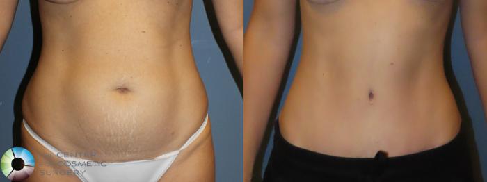 Best Denver Tummy Tuck Abdominoplasty