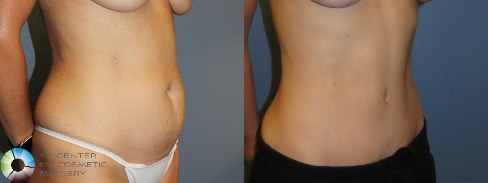 Before & After Tummy Tuck Case 12092 Right Oblique in Denver and Colorado Springs, CO