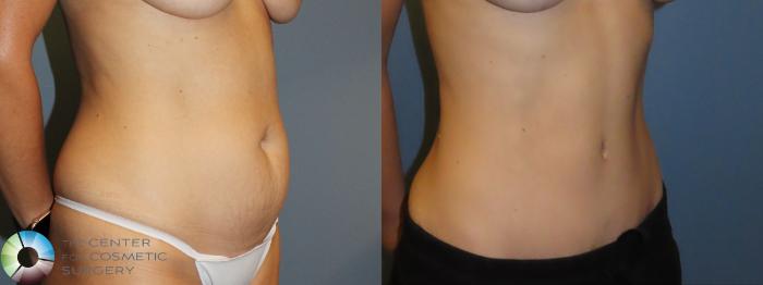 Best Denver Tummy Tuck Abdominoplasty