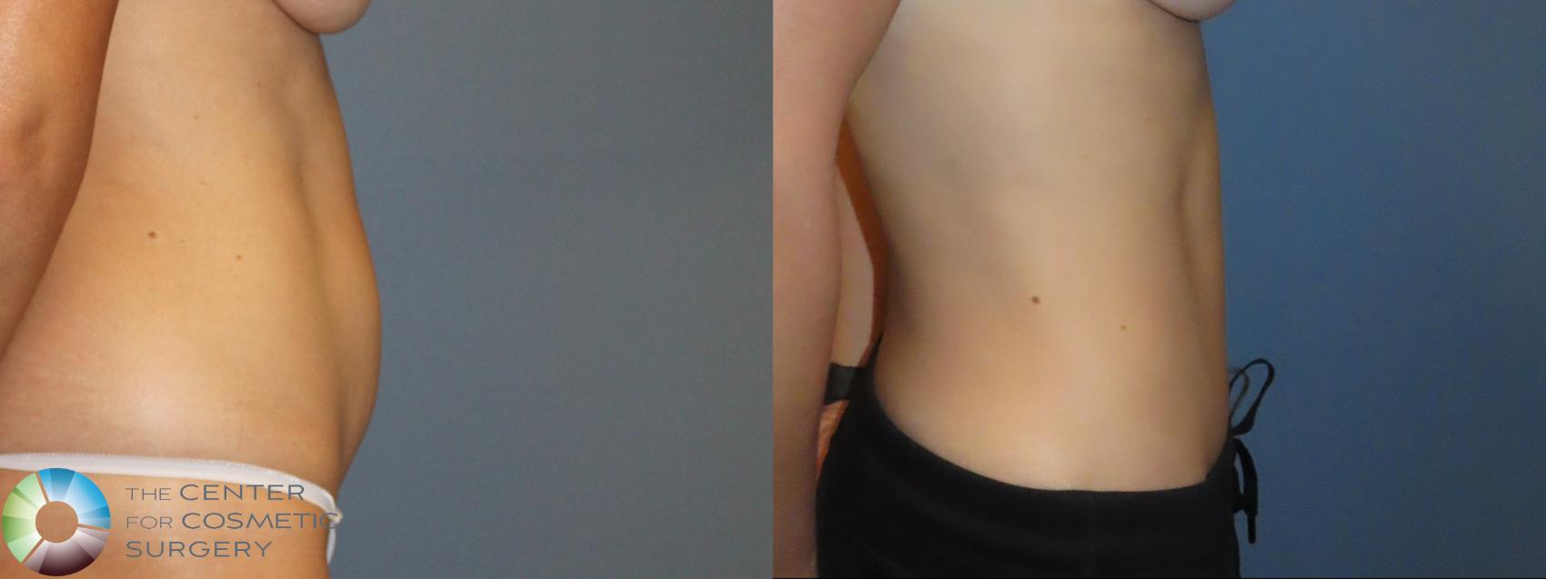 Before & After Tummy Tuck Case 12092 Right Side in Denver and Colorado Springs, CO