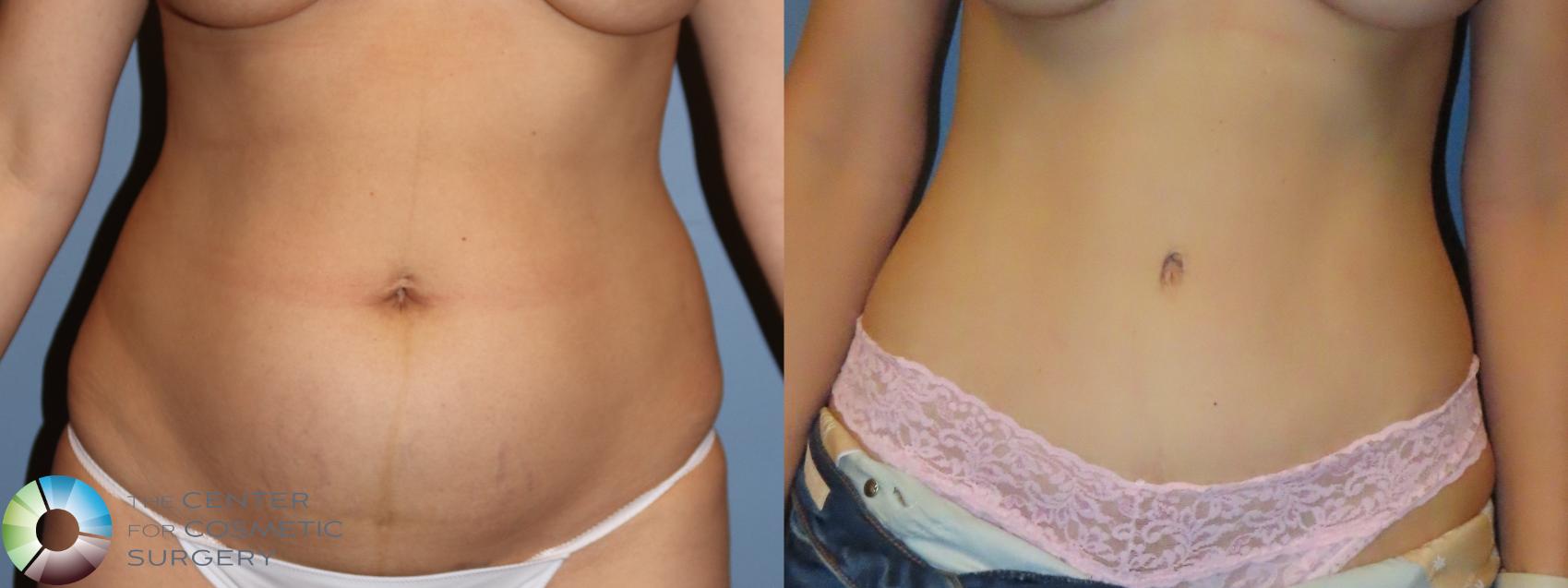 Before & After Tummy Tuck Case 12095 Front in Denver and Colorado Springs, CO