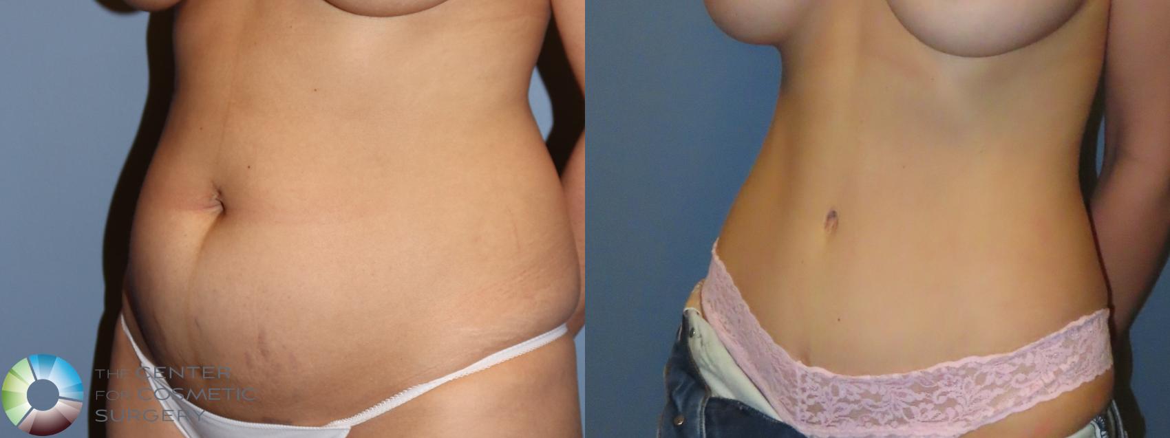 Best Denver Tummy Tuck Abdominoplasty