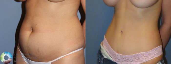 Best Denver Tummy Tuck Abdominoplasty