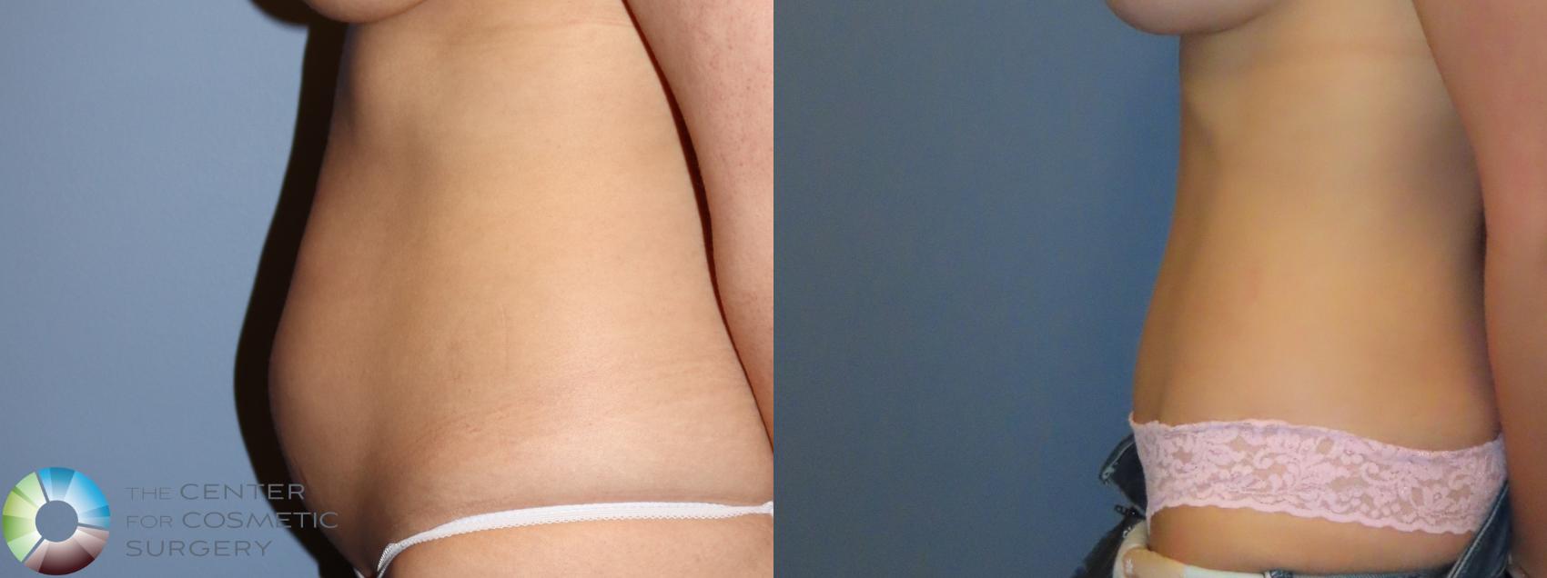 Before & After Tummy Tuck Case 12095 Left Side in Denver and Colorado Springs, CO