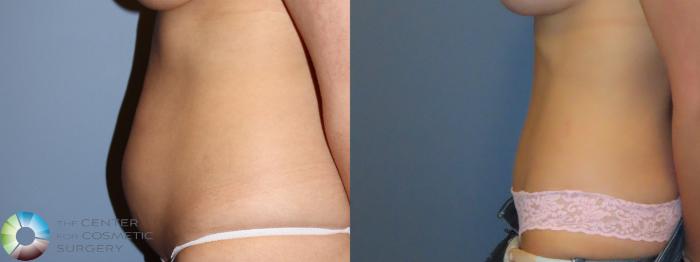 Best Denver Tummy Tuck Abdominoplasty