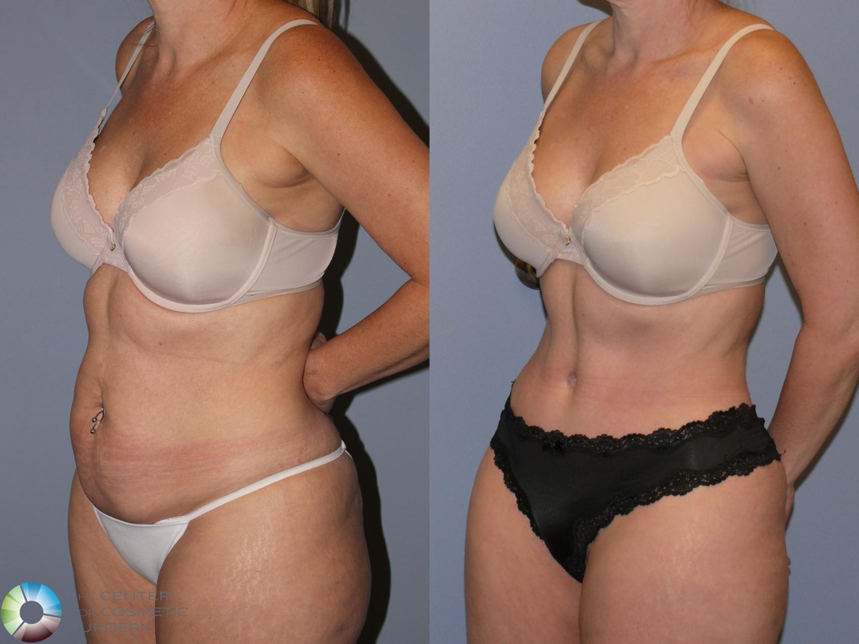 Before & After Tummy Tuck Case 12130 Left Oblique in Denver and Colorado Springs, CO