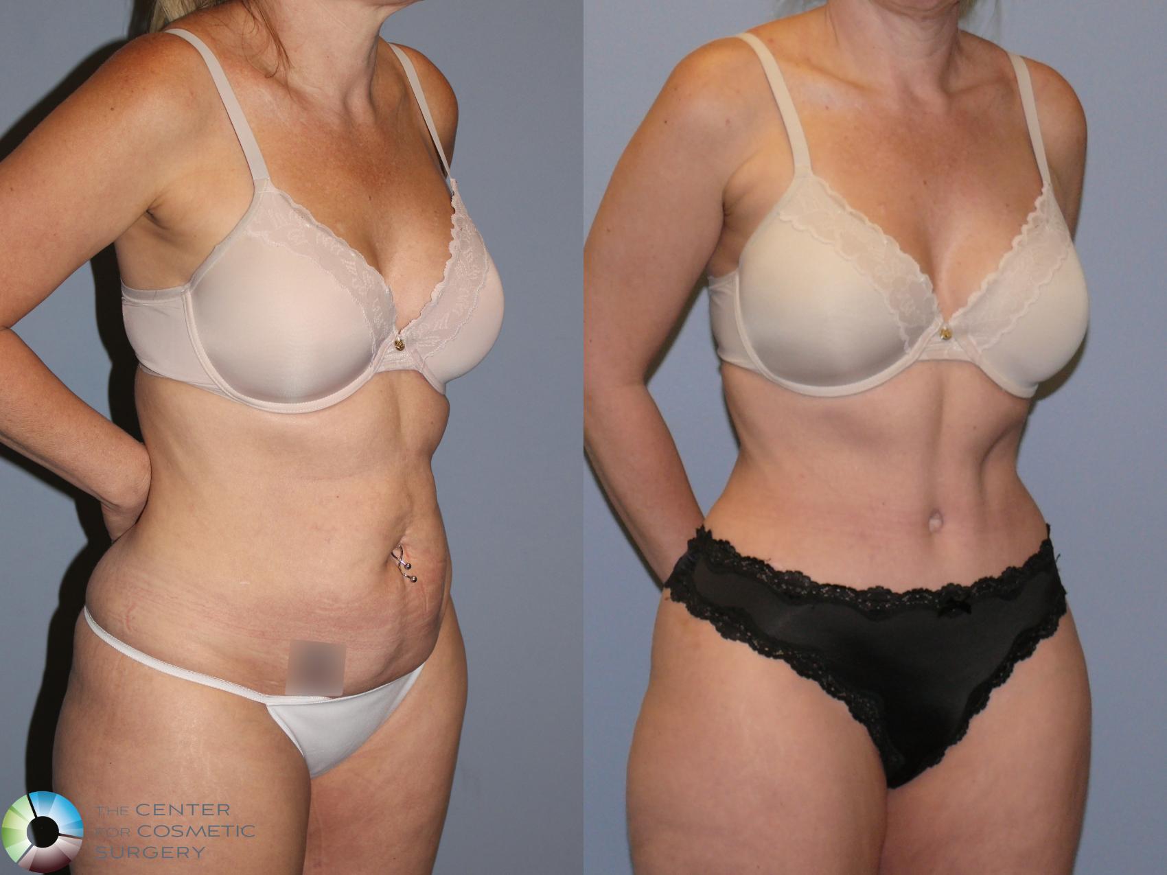 Before & After Tummy Tuck Case 12130 Right Oblique in Denver and Colorado Springs, CO