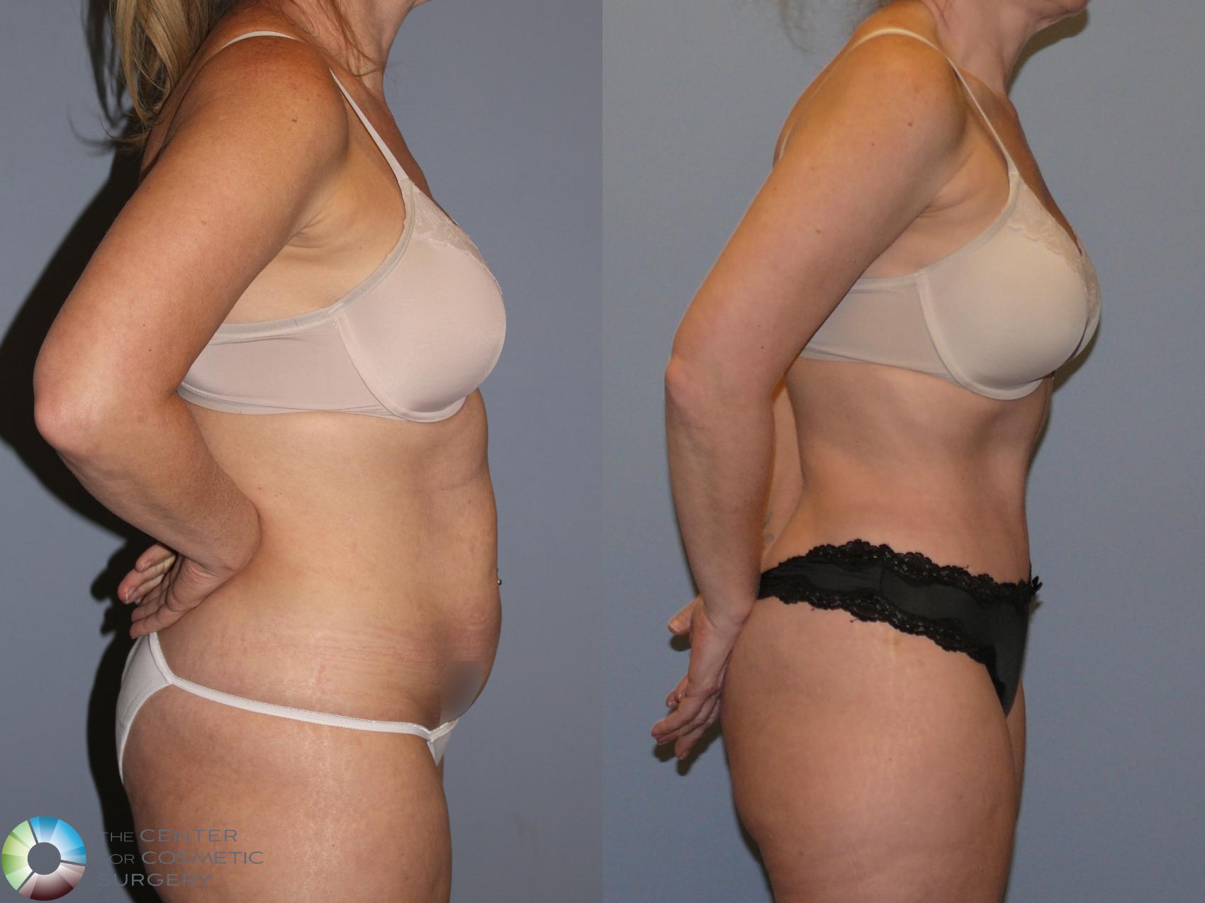 Before & After Tummy Tuck Case 12130 Right Side in Denver and Colorado Springs, CO