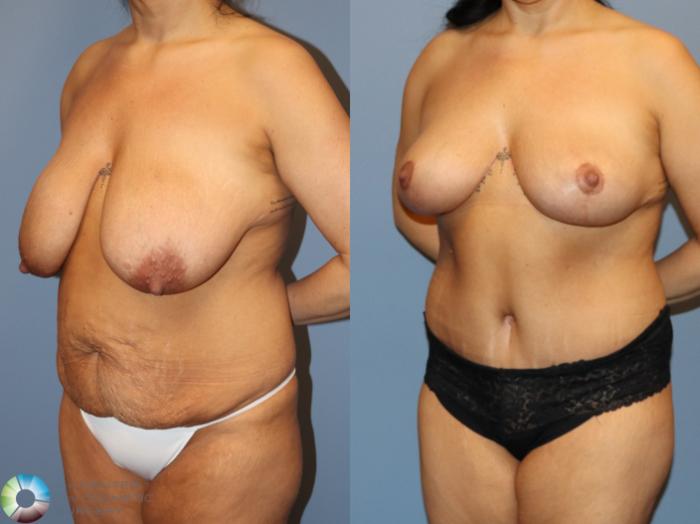 Before & After Tummy Tuck Case 12159 Left Oblique in Denver and Colorado Springs, CO