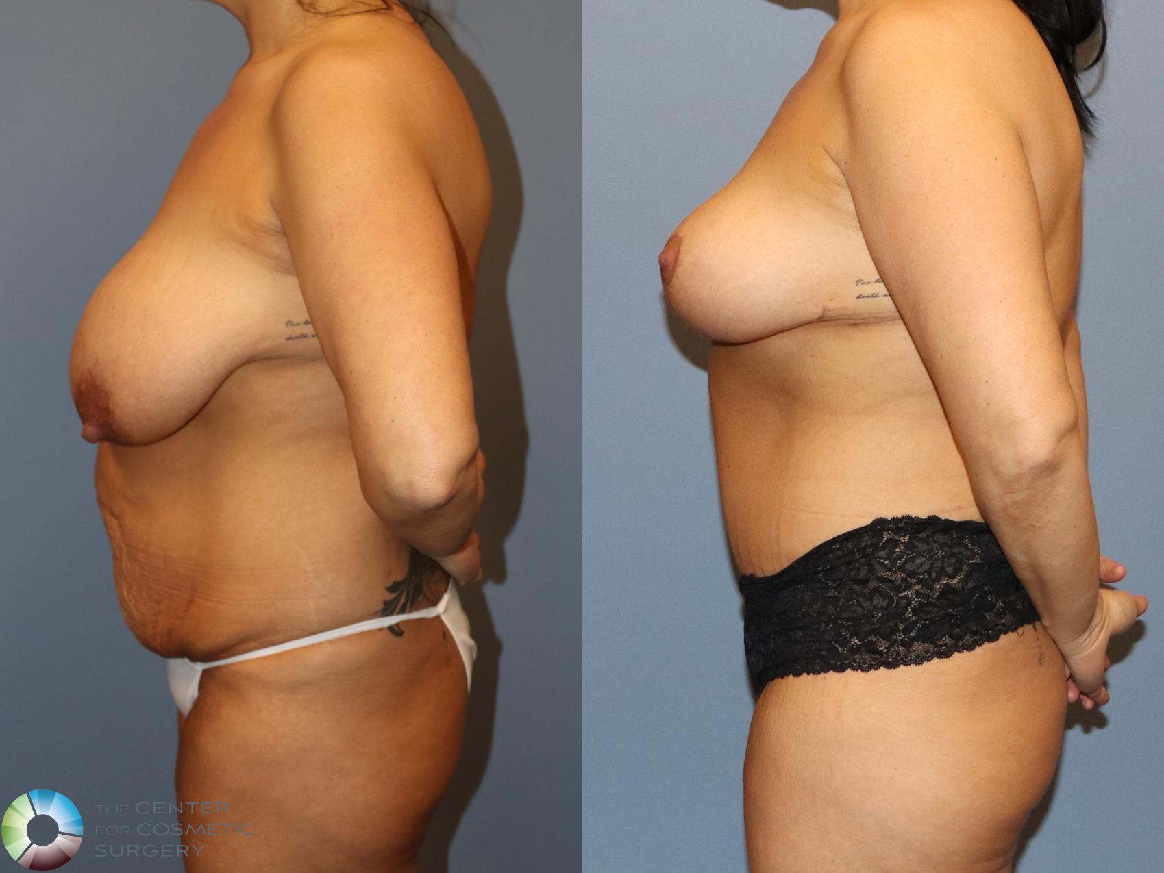 Before & After Tummy Tuck Case 12159 Left Side in Denver and Colorado Springs, CO