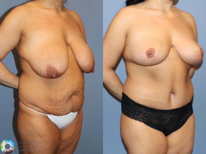 Before & After Tummy Tuck Case 12159 Right Oblique in Denver and Colorado Springs, CO