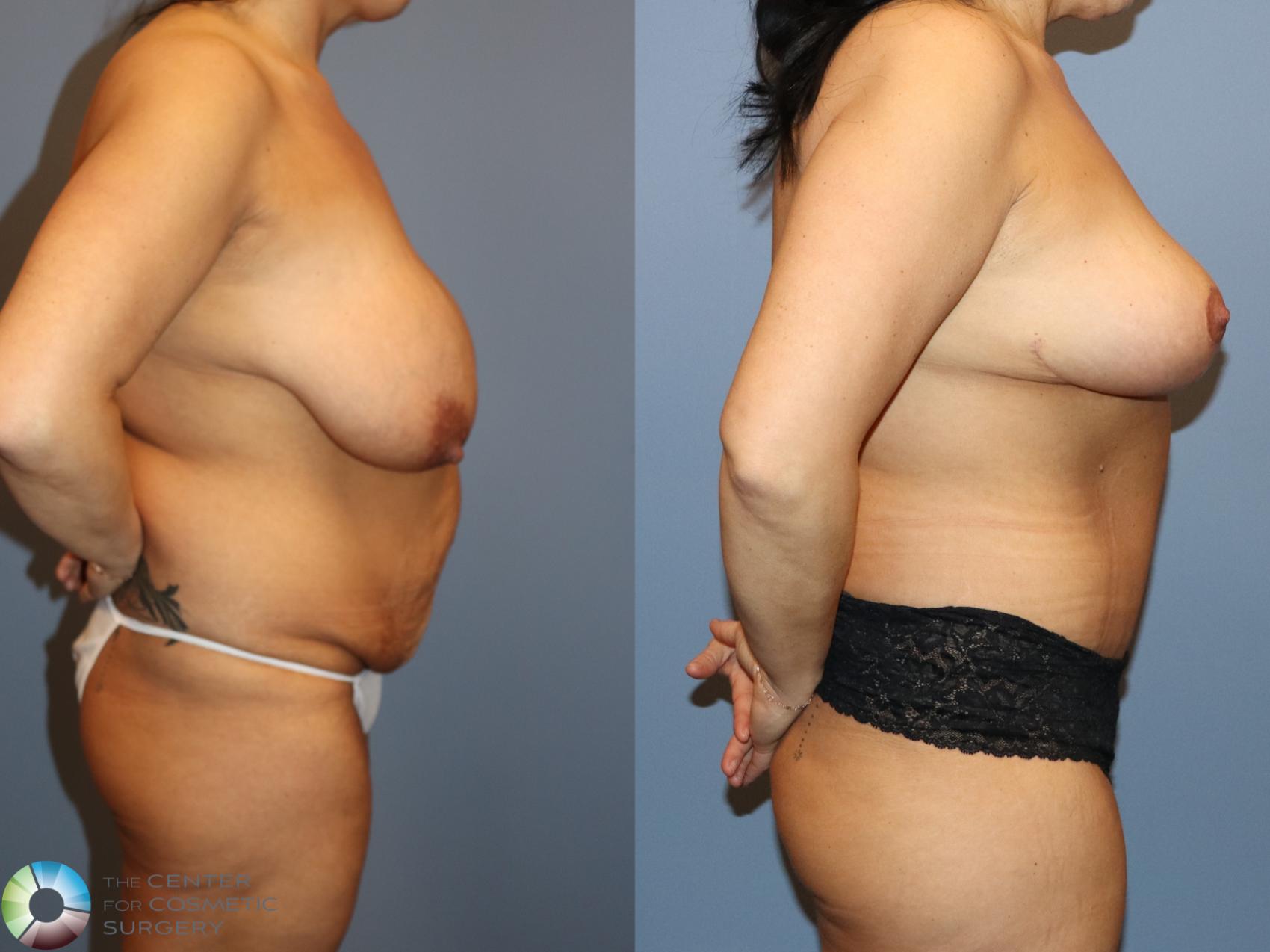 Before & After Tummy Tuck Case 12159 Right Side in Denver and Colorado Springs, CO