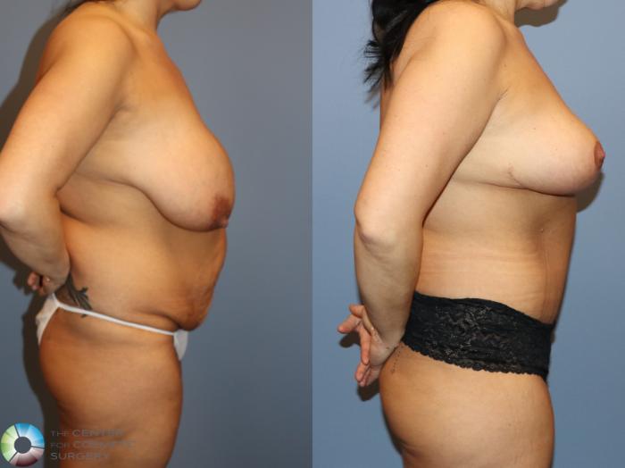 Before & After Tummy Tuck Case 12159 Right Side in Denver and Colorado Springs, CO